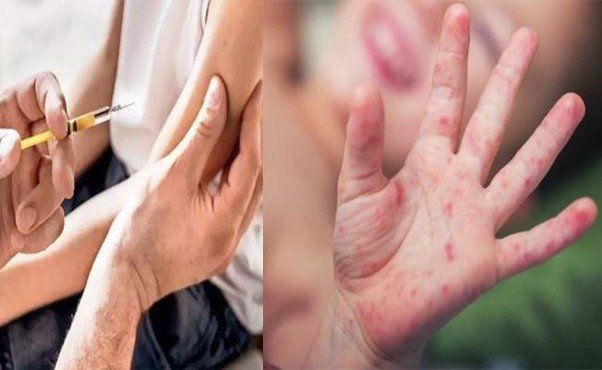 Measles outbreak intensifies in Malappuram district: Health department steps up preventive measures